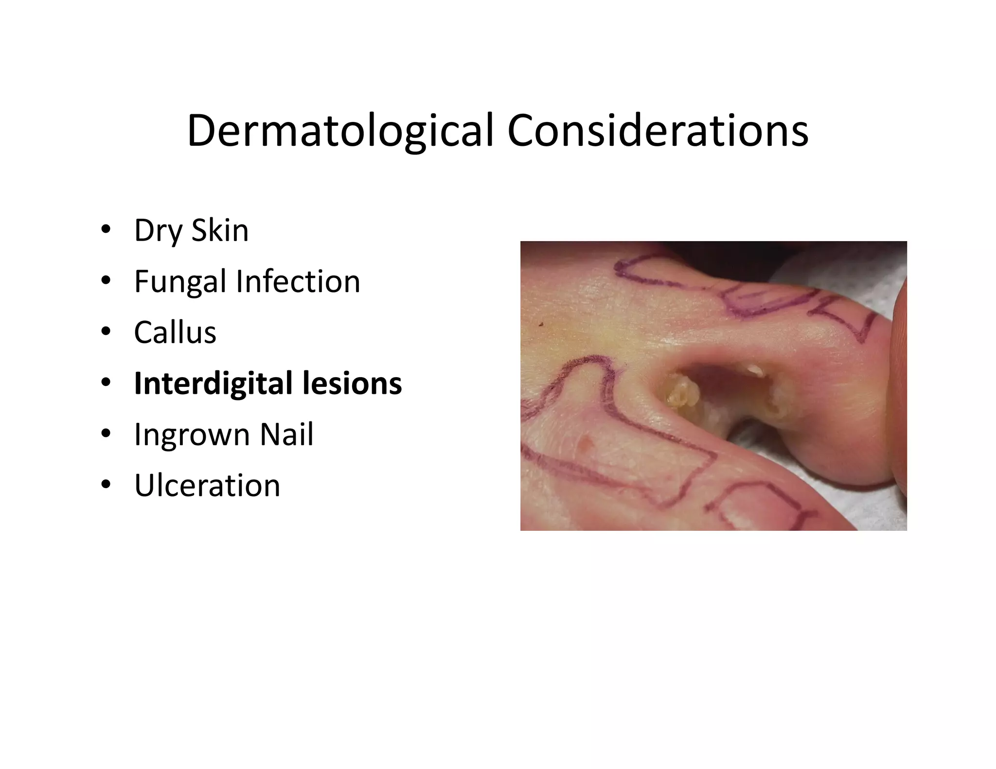 Dermatological Considerations
•   Dry Skin
•   Fungal Infection
•   Callus
•   Interdigital lesions
•   Ingrown Nail
•   Ulceration
 