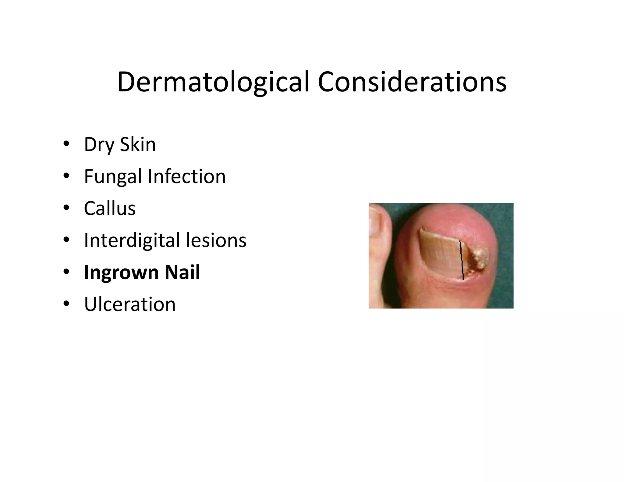 Dermatological Considerations
•   Dry Skin
•   Fungal Infection
•   Callus
•   Interdigital lesions
•   Ingrown Nail
•   Ulceration
 