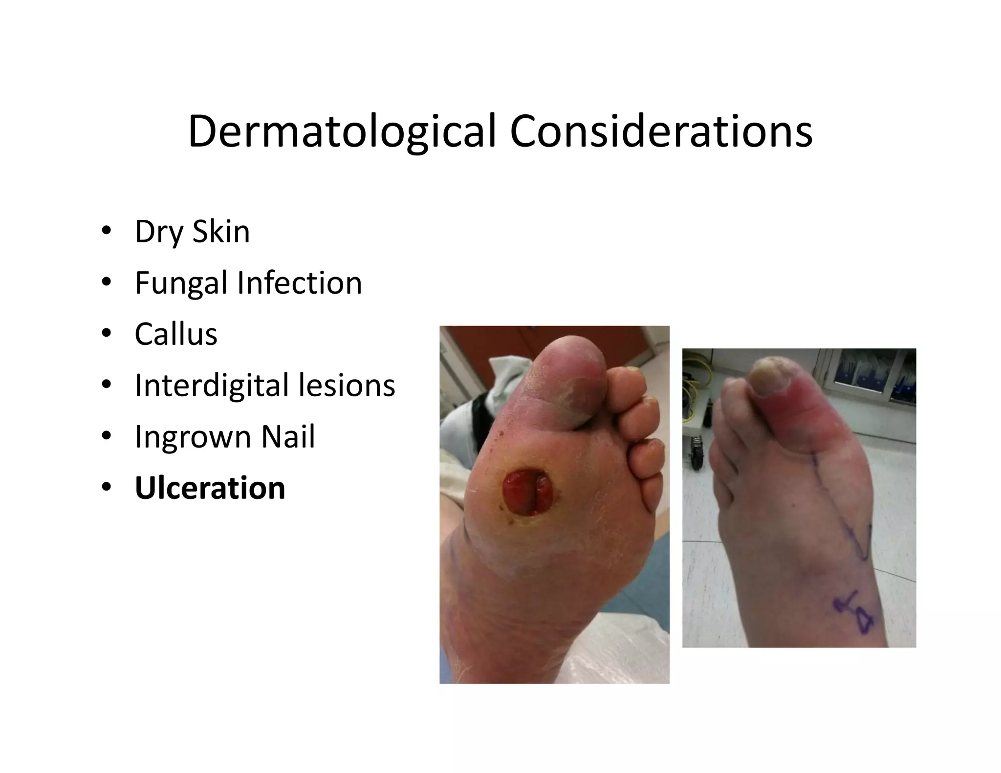 Dermatological Considerations
•   Dry Skin
•   Fungal Infection
•   Callus
•   Interdigital lesions
•   Ingrown Nail
•   Ulceration
 