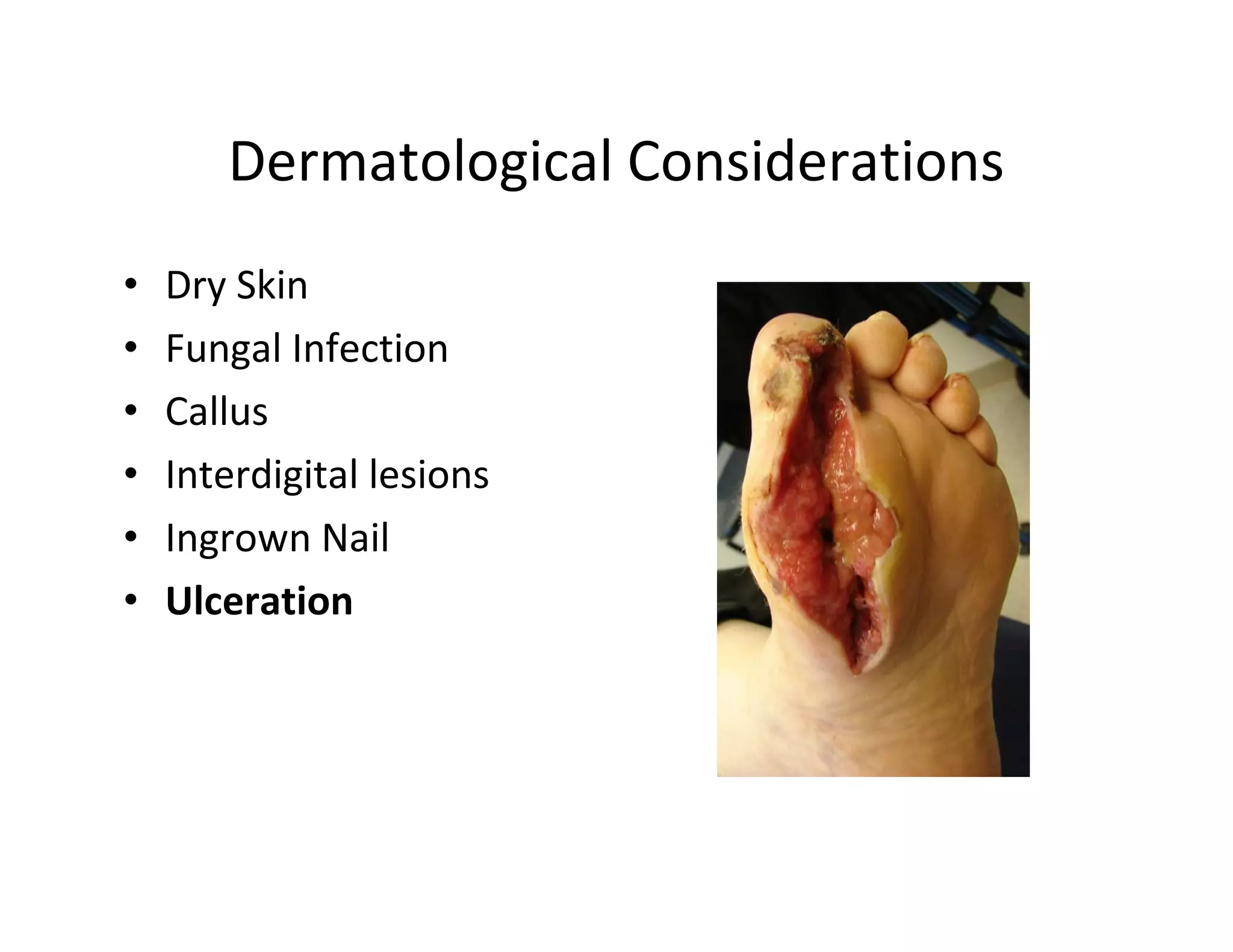 Dermatological Considerations
•   Dry Skin
•   Fungal Infection
•   Callus
•   Interdigital lesions
•   Ingrown Nail
•   Ulceration
 