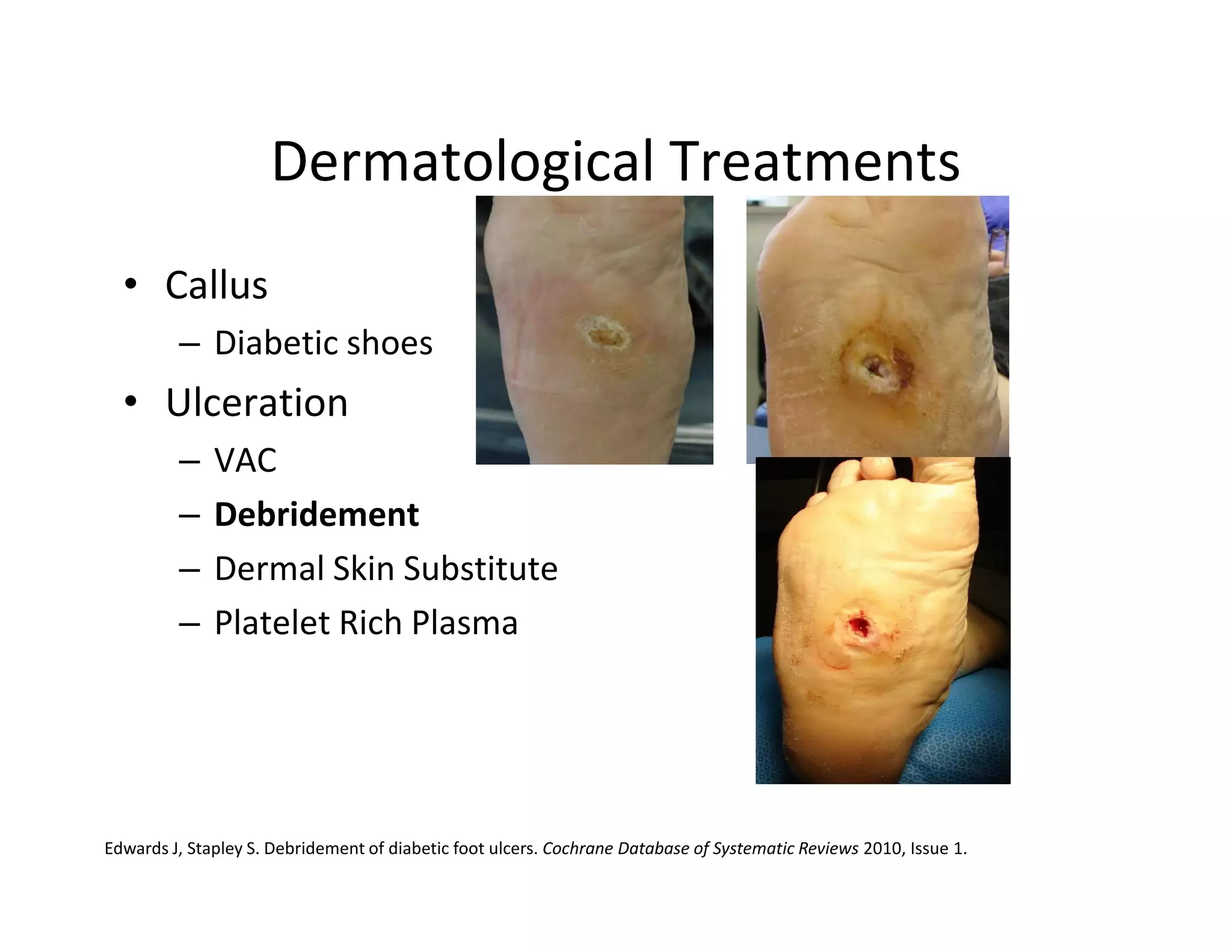 Dermatological Treatments
  • Callus
         – Diabetic shoes
  • Ulceration
         –    VAC
         –    Debridement
         –    Dermal Skin Substitute
         –    Platelet Rich Plasma




Edwards J, Stapley S. Debridement of diabetic foot ulcers. Cochrane Database of Systematic Reviews 2010, Issue 1.
 