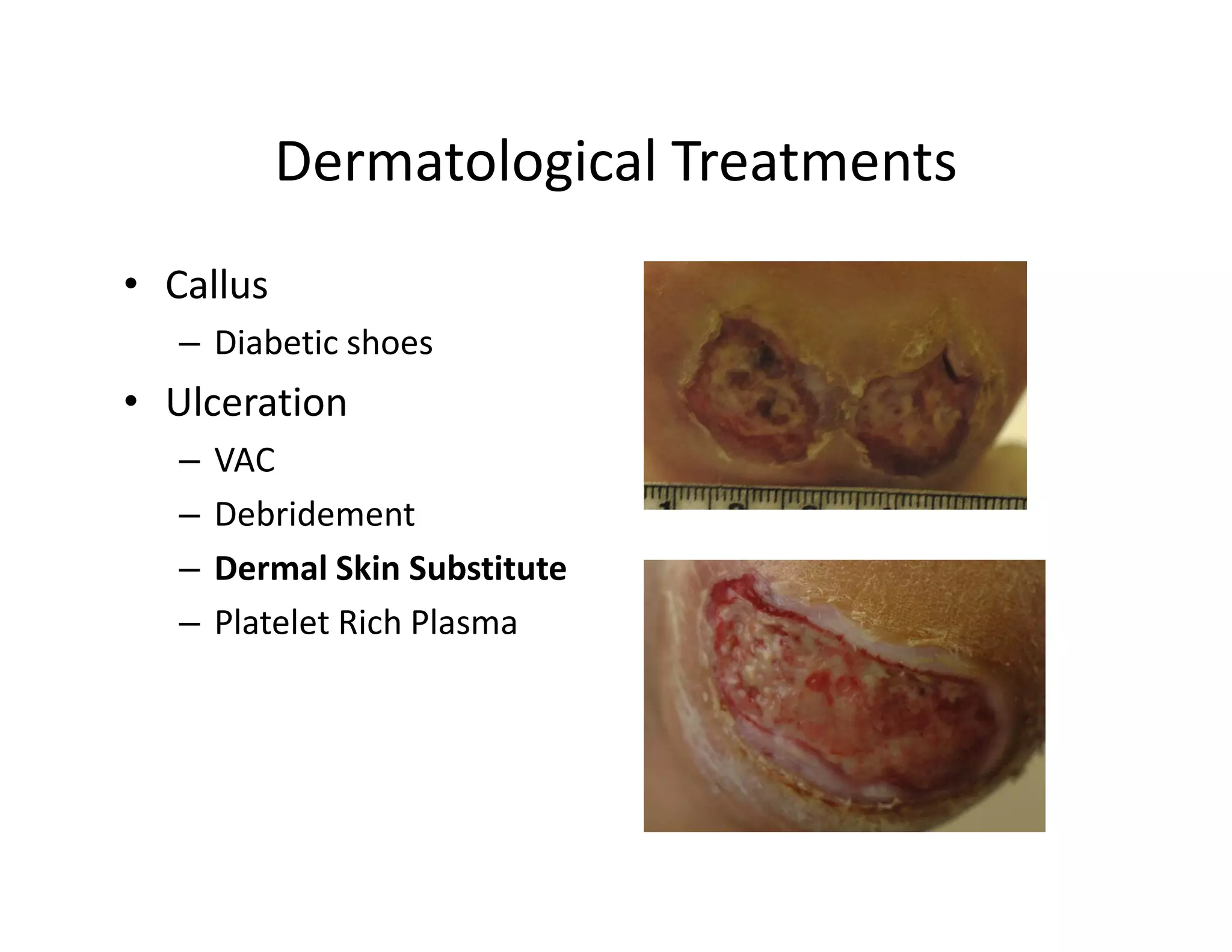 Dermatological Treatments
• Callus
   – Diabetic shoes
• Ulceration
   –   VAC
   –   Debridement
   –   Dermal Skin Substitute
   –   Platelet Rich Plasma
 