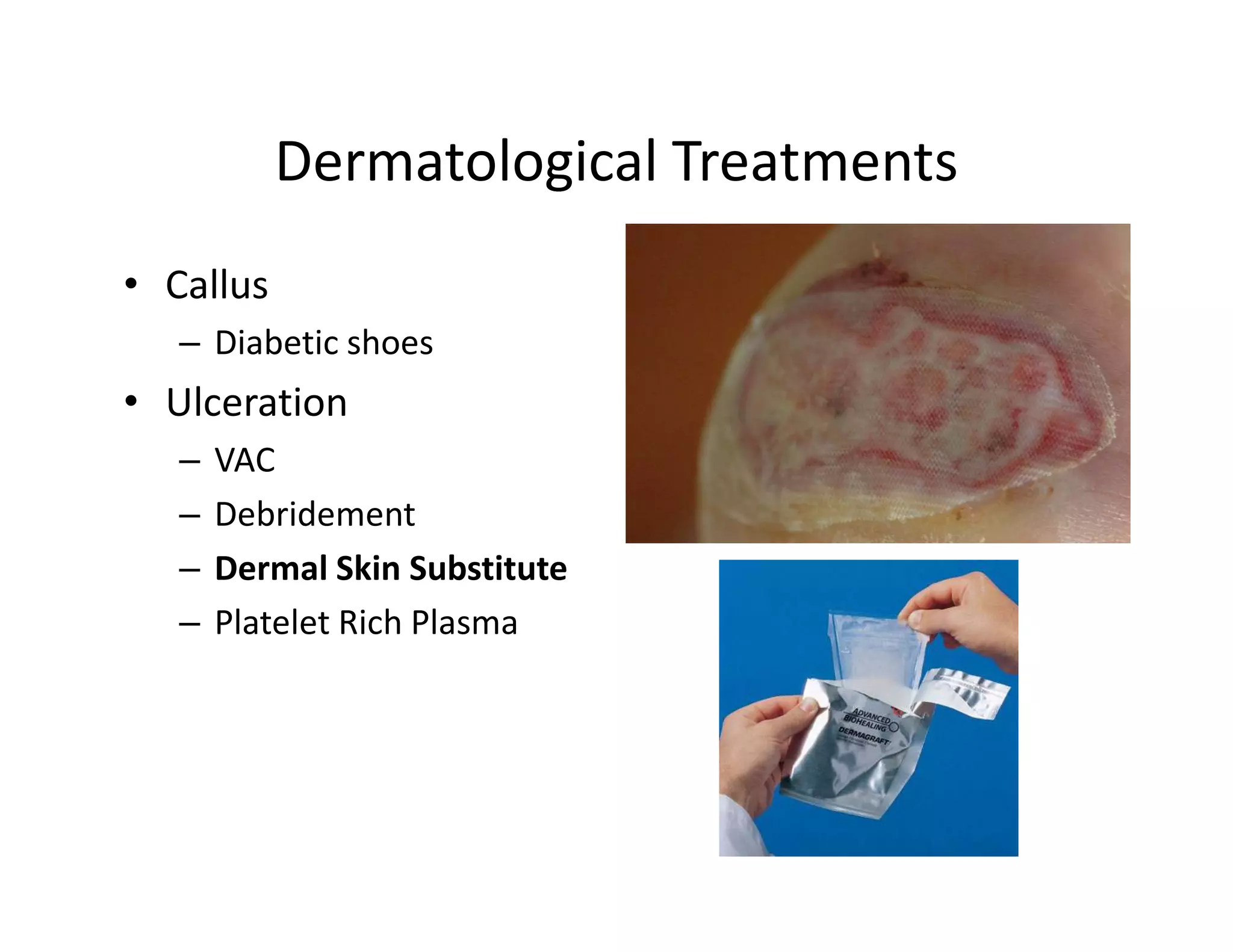 Dermatological Treatments
• Callus
   – Diabetic shoes
• Ulceration
   –   VAC
   –   Debridement
   –   Dermal Skin Substitute
   –   Platelet Rich Plasma
 