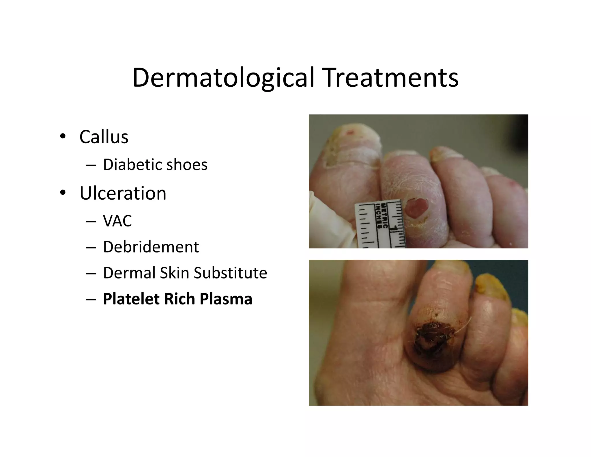 Dermatological Treatments
• Callus
   – Diabetic shoes
• Ulceration
   –   VAC
   –   Debridement
   –   Dermal Skin Substitute
   –   Platelet Rich Plasma
 