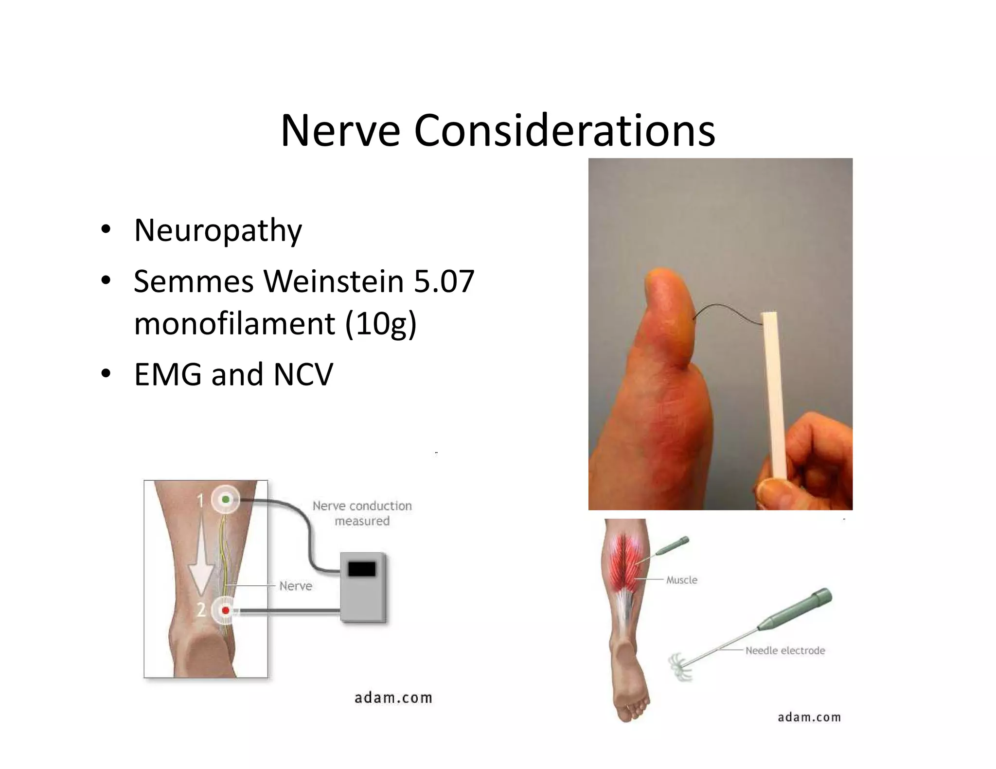 Nerve Considerations
• Neuropathy
• Semmes Weinstein 5.07
  monofilament (10g)
• EMG and NCV
 