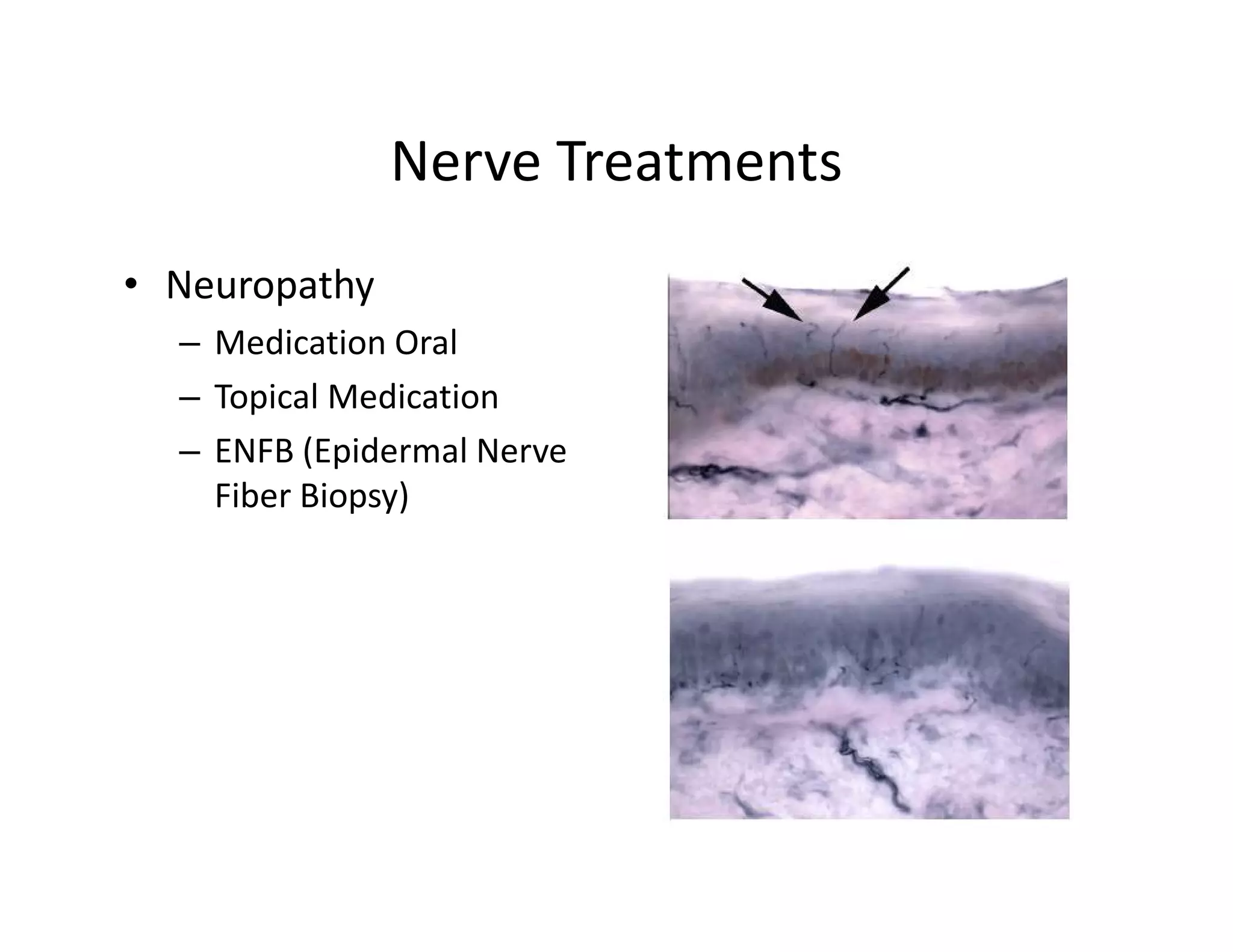Nerve Treatments
• Neuropathy
  – Medication Oral
  – Topical Medication
  – ENFB (Epidermal Nerve
    Fiber Biopsy)
 