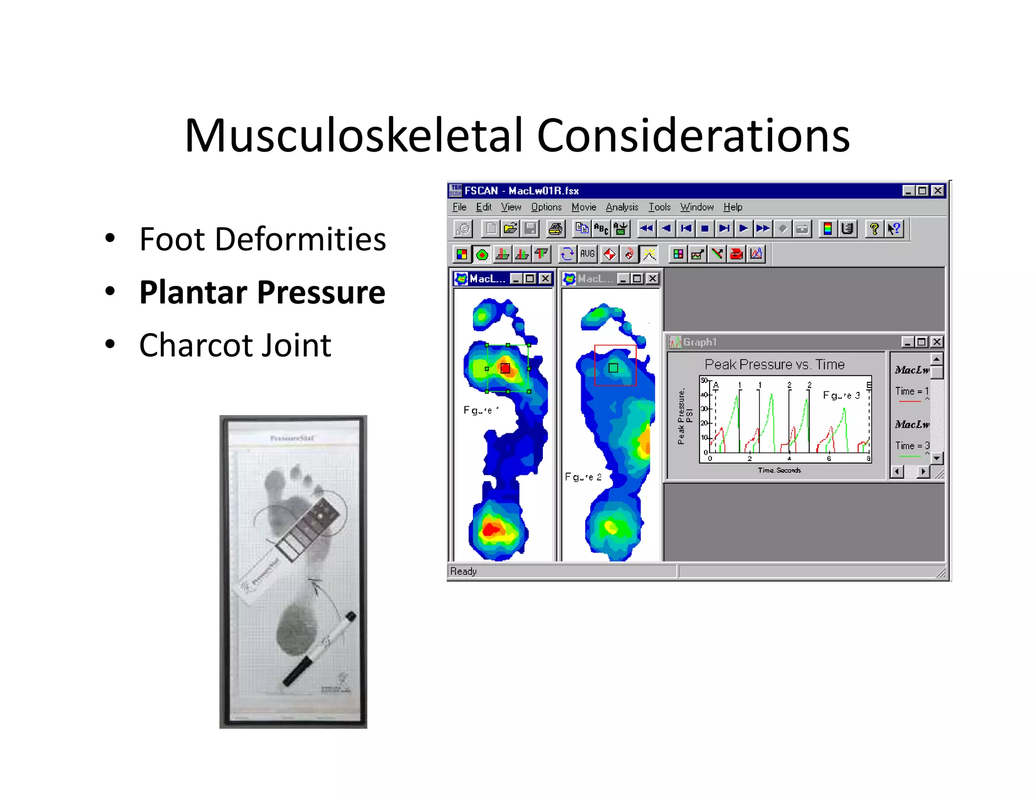 Musculoskeletal Considerations
• Foot Deformities
• Plantar Pressure
• Charcot Joint
 