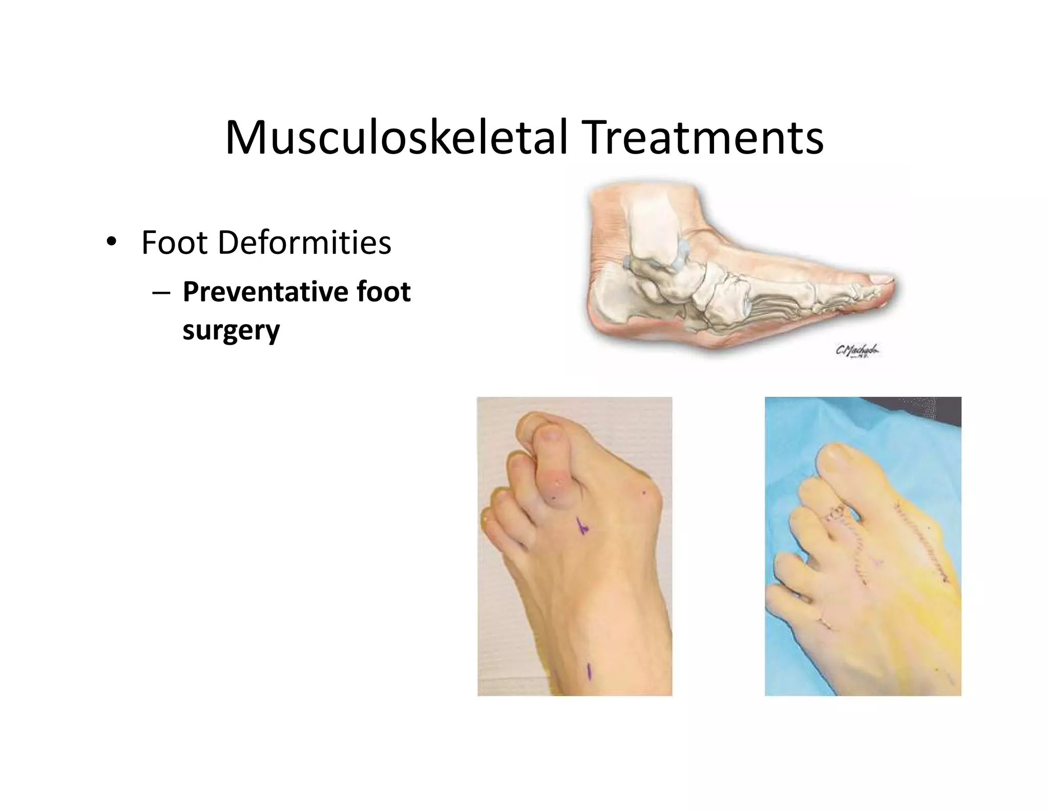 Musculoskeletal Treatments
• Foot Deformities
  – Preventative foot
    surgery
 