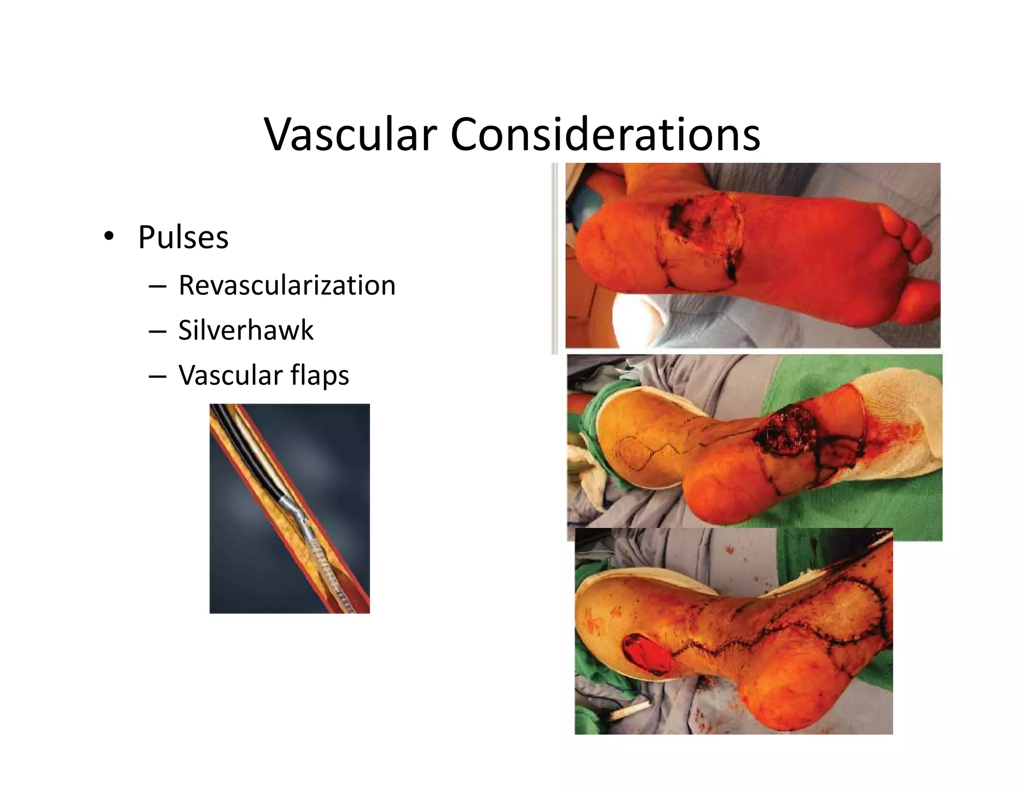 Vascular Considerations
• Pulses
  – Revascularization
  – Silverhawk
  – Vascular flaps
 
