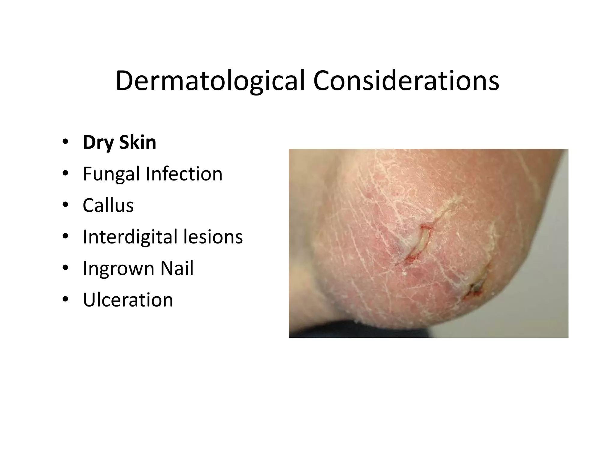 Dermatological Considerations
•   Dry Skin
•   Fungal Infection
•   Callus
•   Interdigital lesions
•   Ingrown Nail
•   Ulceration
 