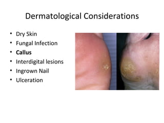 Dermatological Considerations Dry Skin Fungal Infection Callus Interdigital lesions Ingrown Nail Ulceration 