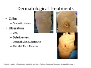 Dermatological Treatments Callus Diabetic shoes Ulceration VAC Debridement Dermal Skin Substitute Platelet Rich Plasma Edwards J, Stapley S. Debridement of diabetic foot ulcers.  Cochrane Database of Systematic Reviews  2010, Issue 1.  