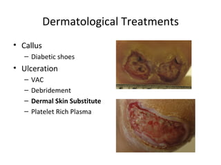 Dermatological Treatments Callus Diabetic shoes Ulceration VAC Debridement Dermal Skin Substitute Platelet Rich Plasma 