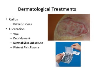 Dermatological Treatments Callus Diabetic shoes Ulceration VAC Debridement Dermal Skin Substitute Platelet Rich Plasma 