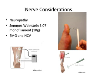 Nerve Considerations Neuropathy Semmes Weinstein 5.07 monofilament (10g) EMG and NCV 