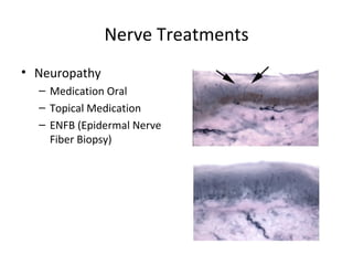 Nerve Treatments Neuropathy Medication Oral Topical Medication ENFB (Epidermal Nerve Fiber Biopsy) 