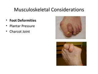 Musculoskeletal Considerations Foot Deformities Plantar Pressure  Charcot Joint 