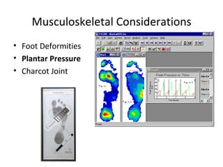 Musculoskeletal Considerations Foot Deformities Plantar Pressure   Charcot Joint 