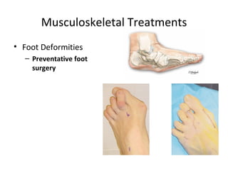 Musculoskeletal Treatments Foot Deformities Preventative foot surgery 