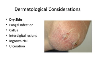 Dermatological Considerations Dry Skin Fungal Infection Callus Interdigital lesions Ingrown Nail Ulceration 