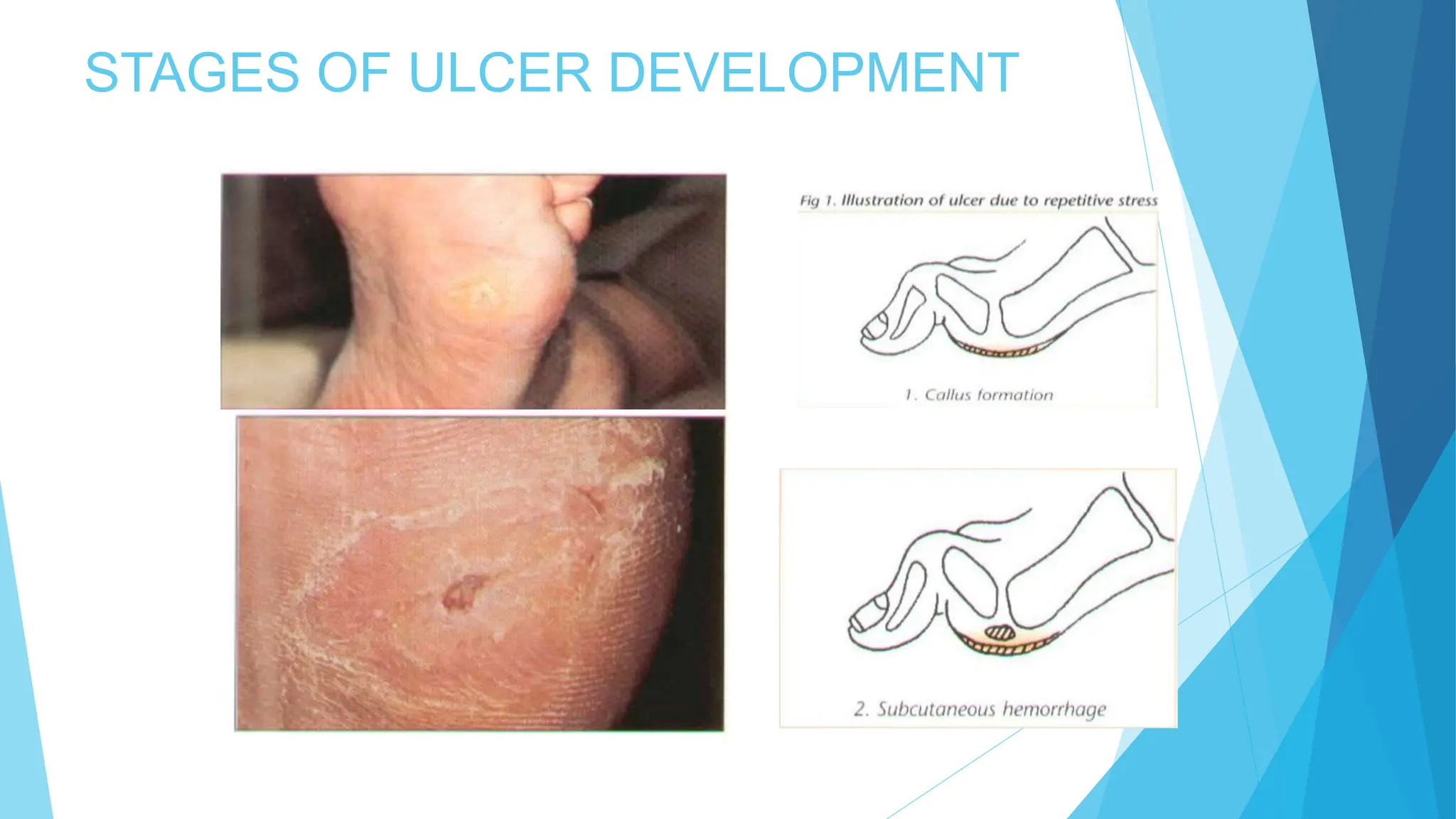 Diabetic Foot management protocol for medical students | PPTX