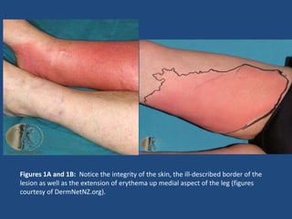 Figures 1A and 1B: Notice the integrity of the skin, the ill-described border of the 
lesion as well as the extension of erythema up medial aspect of the leg (figures 
courtesy of DermNetNZ.org). 
 