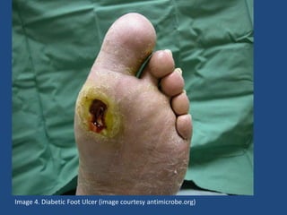 Image 4. Diabetic Foot Ulcer (image courtesy antimicrobe.org) 
 