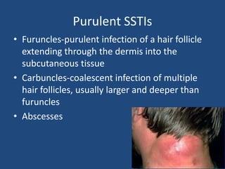 Purulent SSTIs 
• Furuncles-purulent infection of a hair follicle 
extending through the dermis into the 
subcutaneous tissue 
• Carbuncles-coalescent infection of multiple 
hair follicles, usually larger and deeper than 
furuncles 
• Abscesses 
 