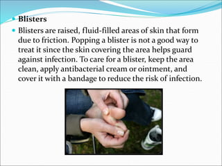  Blisters
 Blisters are raised, fluid-filled areas of skin that form
due to friction. Popping a blister is not a good way to
treat it since the skin covering the area helps guard
against infection. To care for a blister, keep the area
clean, apply antibacterial cream or ointment, and
cover it with a bandage to reduce the risk of infection.
 