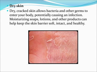  Dry skin
 Dry, cracked skin allows bacteria and other germs to
enter your body, potentially causing an infection.
Moisturizing soaps, lotions, and other products can
help keep the skin barrier soft, intact, and healthy.
 