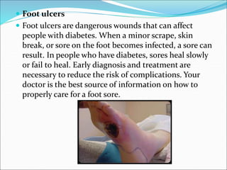  Foot ulcers
 Foot ulcers are dangerous wounds that can affect
people with diabetes. When a minor scrape, skin
break, or sore on the foot becomes infected, a sore can
result. In people who have diabetes, sores heal slowly
or fail to heal. Early diagnosis and treatment are
necessary to reduce the risk of complications. Your
doctor is the best source of information on how to
properly care for a foot sore.
 