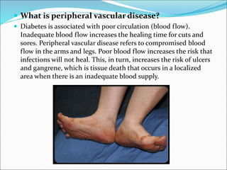  What is peripheral vascular disease?
 Diabetes is associated with poor circulation (blood flow).
Inadequate blood flow increases the healing time for cuts and
sores. Peripheral vascular disease refers to compromised blood
flow in the arms and legs. Poor blood flow increases the risk that
infections will not heal. This, in turn, increases the risk of ulcers
and gangrene, which is tissue death that occurs in a localized
area when there is an inadequate blood supply.
 