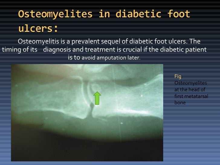 Diabetic Foot Ulcer