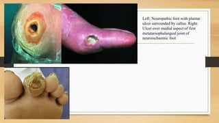 Left: Neuropathic foot with plantar
ulcer surrounded by callus. Right:
Ulcer over medial aspect of first
metatarsophalangeal joint of
neuroischaemic foot
 