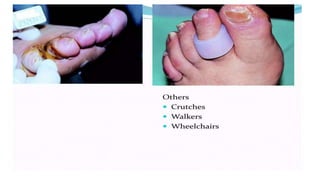 • Others Crutches Walkers Wheelchairs
 