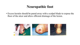 Neuropathic foot
• Excess keratin should be pared away with a scalpel blade to expose the
floor of the ulcer and allow efficient drainage of the lesion.
 