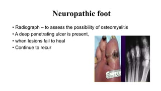 Neuropathic foot
• Radiograph – to assess the possibility of osteomyelitis
• A deep penetrating ulcer is present,
• when lesions fail to heal
• Continue to recur
 