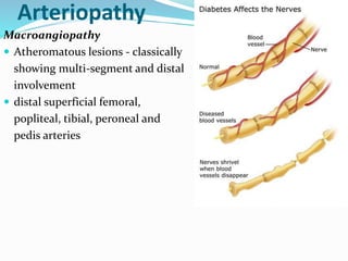 Arteriopathy
Macroangiopathy
 Atheromatous lesions - classically
showing multi-segment and distal
involvement
 distal superficial femoral,
popliteal, tibial, peroneal and
pedis arteries
 