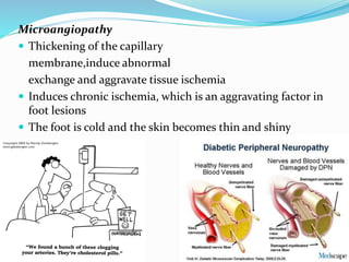 Microangiopathy
 Thickening of the capillary
membrane,induce abnormal
exchange and aggravate tissue ischemia
 Induces chronic ischemia, which is an aggravating factor in
foot lesions
 The foot is cold and the skin becomes thin and shiny
 
