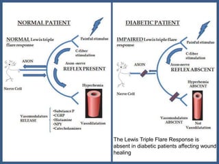 The Lewis Triple Flare Response is
absent in diabetic patients affecting wound
healing
 