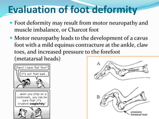 Evaluation of foot deformity
 Foot deformity may result from motor neuropathy and
muscle imbalance, or Charcot foot
 Motor neuropathy leads to the development of a cavus
foot with a mild equinus contracture at the ankle, claw
toes, and increased pressure to the forefoot
(metatarsal heads)
 