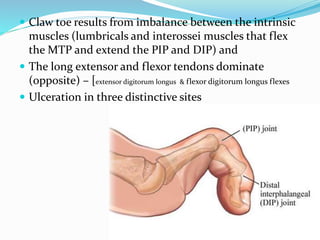  Claw toe results from imbalance between the intrinsic
muscles (lumbricals and interossei muscles that flex
the MTP and extend the PIP and DIP) and
 The long extensor and flexor tendons dominate
(opposite) – [extensor digitorum longus & flexor digitorum longus flexes
 Ulceration in three distinctive sites
 
