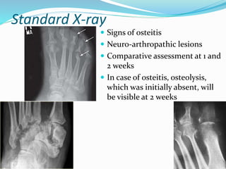 Standard X-ray
 Signs of osteitis
 Neuro-arthropathic lesions
 Comparative assessment at 1 and
2 weeks
 In case of osteitis, osteolysis,
which was initially absent, will
be visible at 2 weeks
 