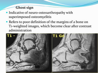 Ghost sign
 Indicative of neuro-osteoarthropathy with
superimposed osteomyelitis
 Refers to poor definition of the margins of a bone on
T1-weighted images, which become clear after contrast
administration
 
