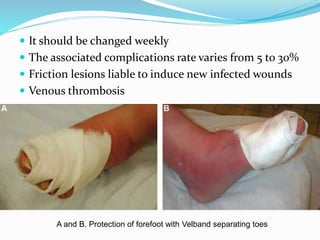  It should be changed weekly
 The associated complications rate varies from 5 to 30%
 Friction lesions liable to induce new infected wounds
 Venous thrombosis
A and B. Protection of forefoot with Velband separating toes
 