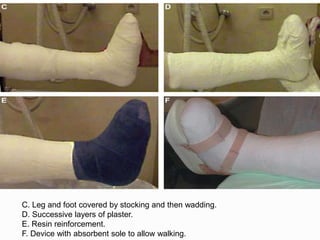C. Leg and foot covered by stocking and then wadding.
D. Successive layers of plaster.
E. Resin reinforcement.
F. Device with absorbent sole to allow walking.
 