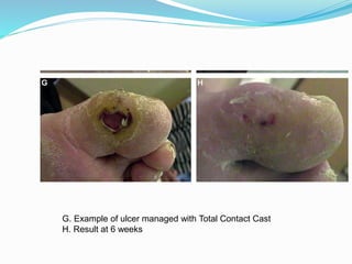 G. Example of ulcer managed with Total Contact Cast
H. Result at 6 weeks
 