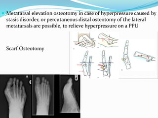  Metatarsal elevation osteotomy in case of hyperpressure caused by
stasis disorder, or percutaneous distal osteotomy of the lateral
metatarsals are possible, to relieve hyperpressure on a PPU
Scarf Osteotomy
 