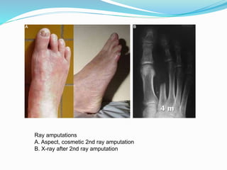 Ray amputations
A. Aspect, cosmetic 2nd ray amputation
B. X-ray after 2nd ray amputation
 