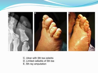 C. Ulcer with 5th toe osteitis
D. Limited cellulitis of 5th toe
E. 5th ray amputation
 